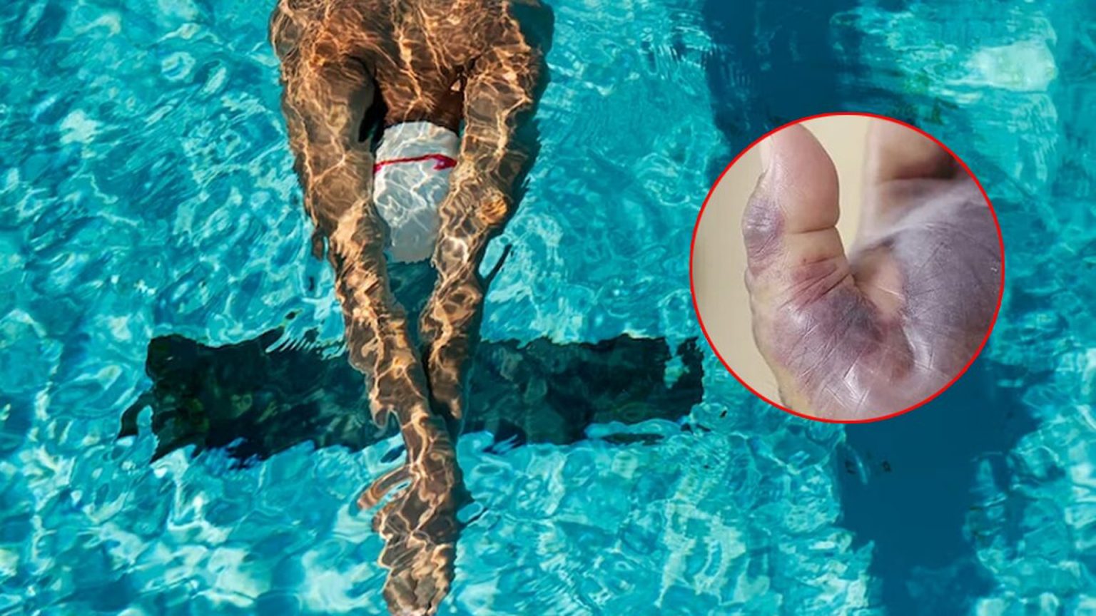 ระวัง “แบคทีเรียกินเนื้อ” เข้าสู่ร่างกายผ่านการว่ายน้ำ อันตรายถึงชีวิต