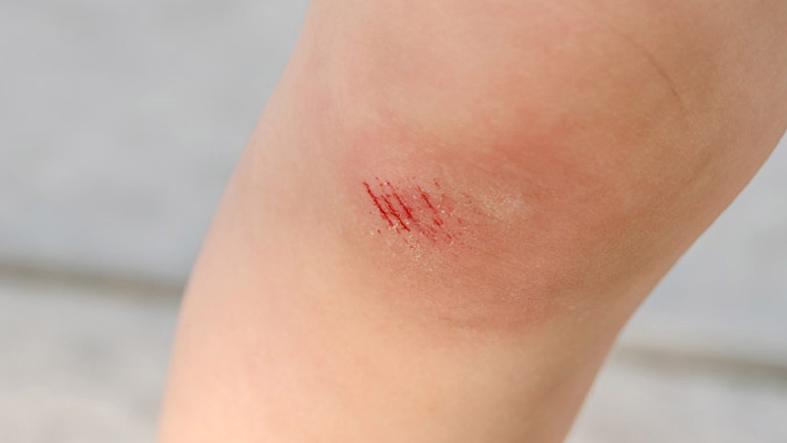 “โรคแบคทีเรียกินเนื้อคน” อันตรายที่มากับแผลไม่สะอาด